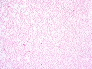 Hemoglobin S/HPFH - 4.