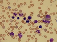 Parvovirus infection mimicking a myeloproliferative neoplasm in a