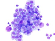 Pleural Fluid Mast Cells - 3.