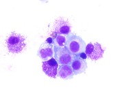 Pleural Fluid Mast Cells - 5.