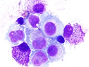 Pleural Fluid Mast Cells - 6.