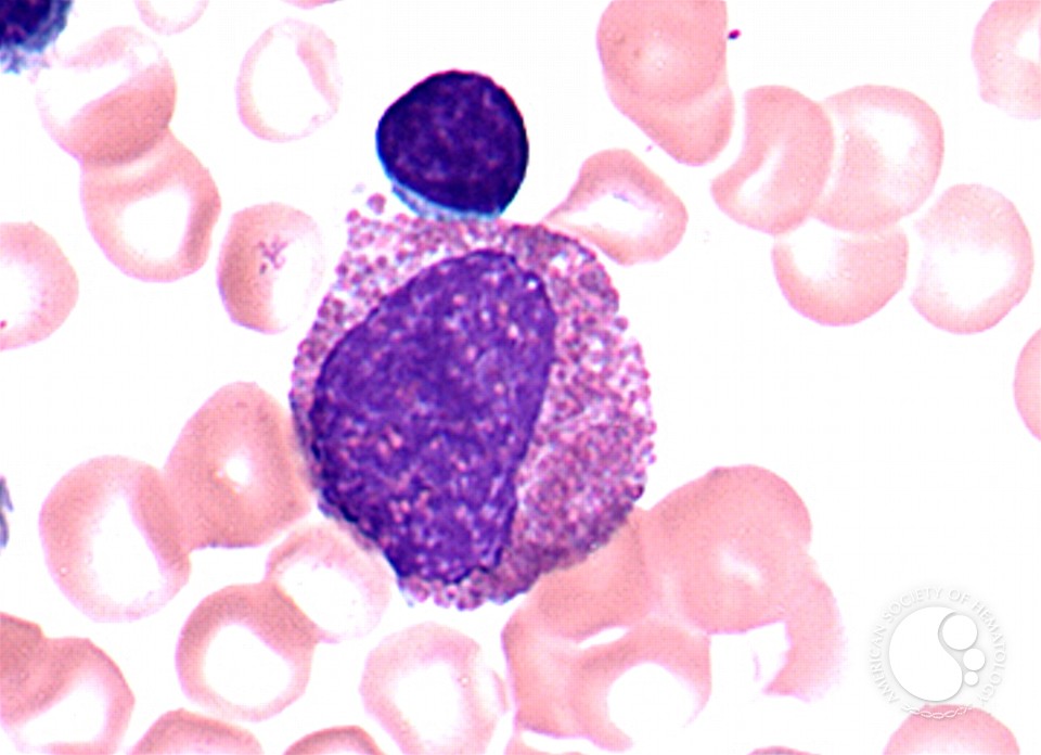 Eosinophilic Myelocyte - 1.