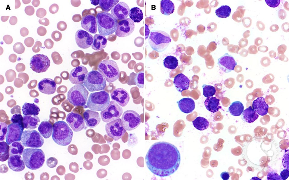 Basophilic blast phase of chronic myelogenous leukemia Basophilic blast phase of chronic myelogenous leukemia