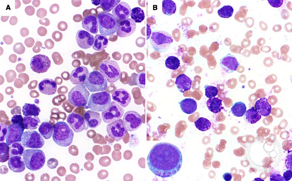 Basophilic blast phase of chronic myelogenous leukemia