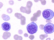 Plasma Cell Leukemia - 3.