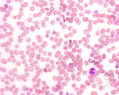 Homozygous Hemoglobin C Disease - 1.