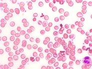 Homozygous Hemoglobin C Disease - 4.