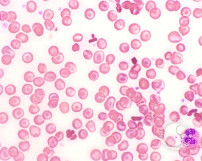 Homozygous Hemoglobin C Disease - 4.