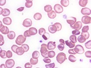 Homozygous Hemoglobin C Disease - 6.