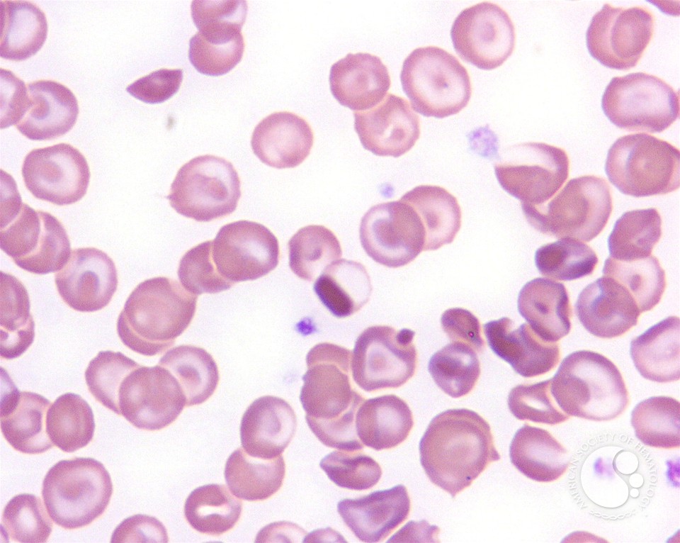 Homozygous Hemoglobin C Disease - 6.