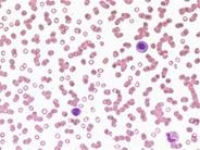 Plasma Cell Leukemia - 1.