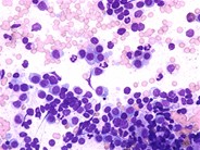 Plasma Cell Leukemia - 2.