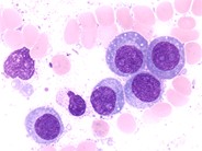 Plasma Cell Leukemia - 3.