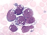 Burkitt Leukemia - 1.