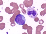 Agnogenic Myeloid Metaplasia - 2.