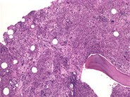 Agnogenic Myeloid Metaplasia - 4.