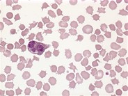Acanthocytosis - 3.