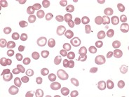 Hemoglobin S/C Disease - 1.