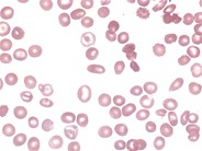 Hemoglobin S/C Disease - 2.