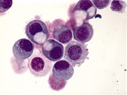 Peritoneal Fluid - Extrinsic Cells - 2.