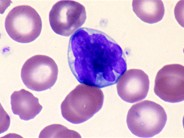 Adult T-cell Leukemia/Lymphoma - 4.