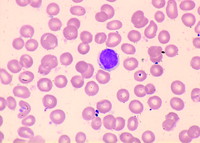 Aggressive NK Cell Leukemia: Blood