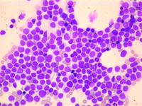 Aggressive NK Cell Leukemia: Marrow Aspirate