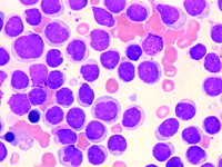 Aggressive NK Cell Leukemia: Marrow Aspirate