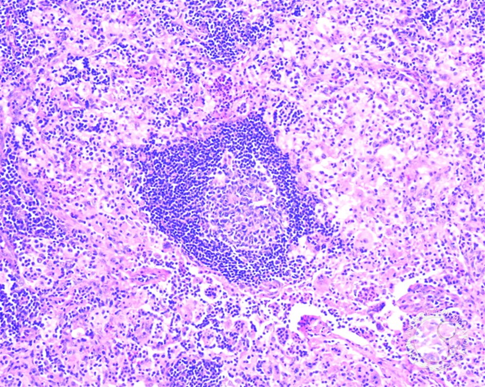 Sinus Histiocytosis With Massive Lymphadenopathy 2