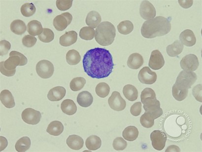 Prolymphocyte - 1.