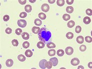 Heart-Shaped Eosinophil - 1.