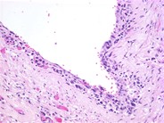 Intravascular Large Cell Lymphoma - 1.