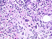 Intravascular Large Cell Lymphoma - 5.