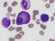 Flame Cells in Multiple Myeloma - 2.