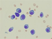 Immature Plasma Cells, Obtained from a Malignant Pleural Effusion - 1.