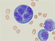 Immature Plasma Cells, Obtained from a Malignant Pleural Effusion - 4.
