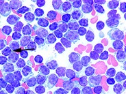 Chronic Lymphocytic Leukemia 3
