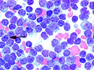 Chronic Lymphocytic Leukemia - 3.