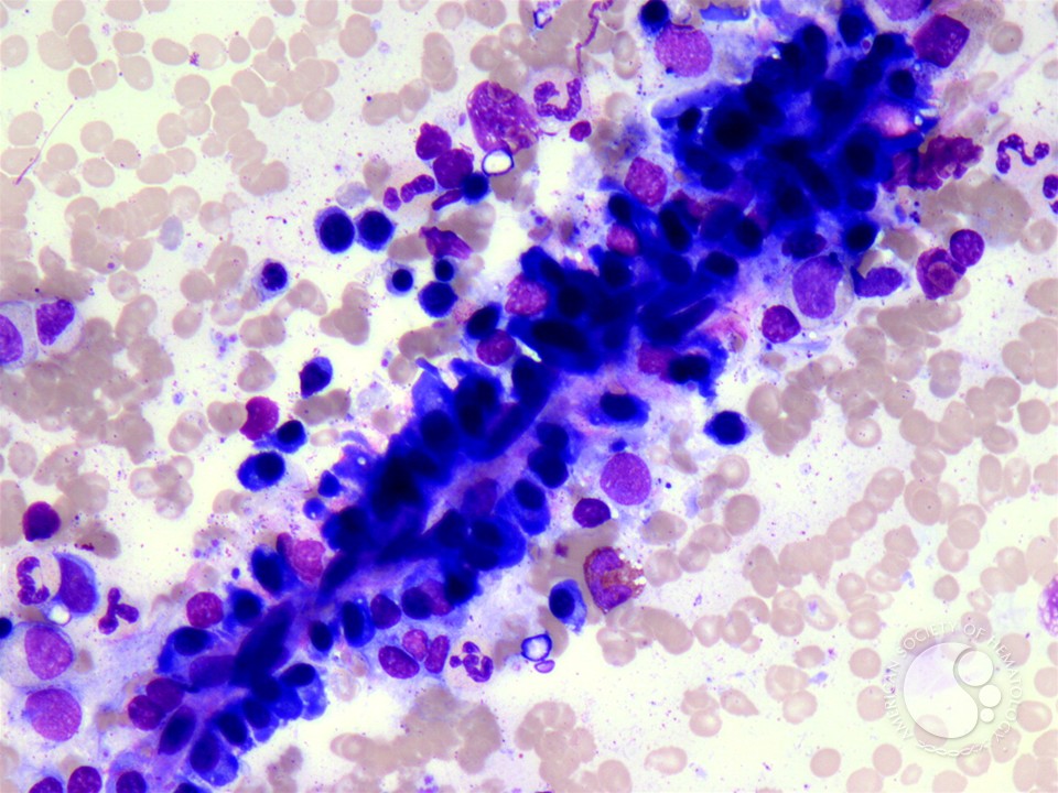 Normal Plasma Cell Distribution Along Bone Marrow Sinusoid - 1.