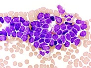 Lymphocyte Agglutination - 2.