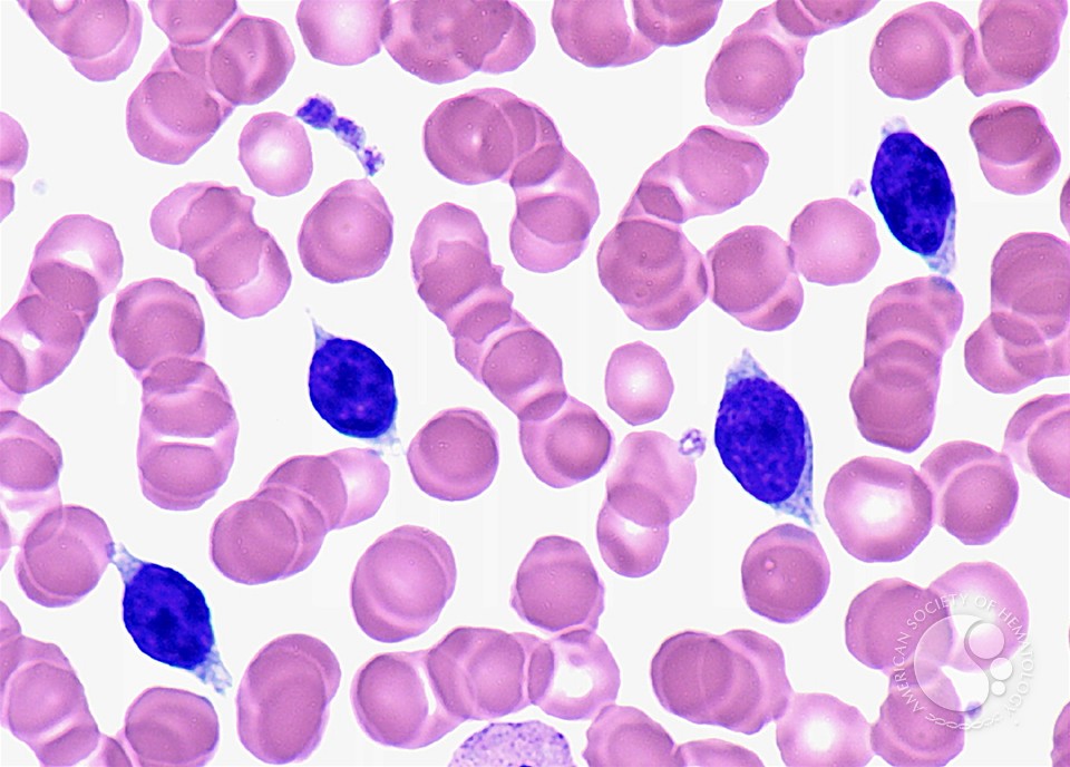 Splenic Marginal Zone Lymphoma With Villous Lymphocytes – Peripheral Blood - 3.