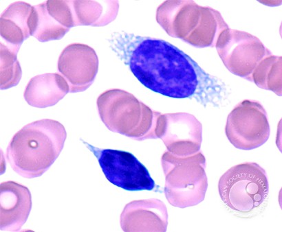 Splenic Marginal Zone Lymphoma With Villous Lymphocytes – Peripheral Blood - 6.