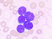 Precursor B-cell Acute Lymphoblastic Leukemia - 2.