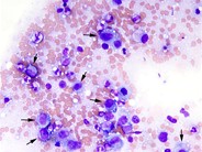 Anaplastic Large Cell Lymphoma Involving the Bone Marrow - 1.