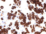 Anaplastic Large Cell Lymphoma Involving the Bone Marrow - 7.