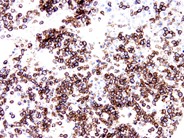 Anaplastic Large Cell Lymphoma Involving the Bone Marrow - 9.