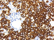 Hairy Cell Leukemia Variant - 7.