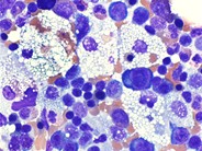 Marrow Histiocytosis - 3.