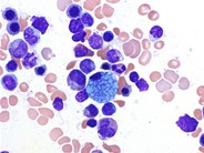 Marrow Histiocytosis - 4.