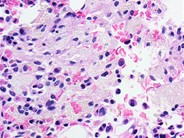 Marrow Histiocytosis - 5.